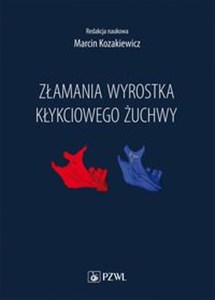 Obrazek Złamania wyrostka kłykciowego żuchwy